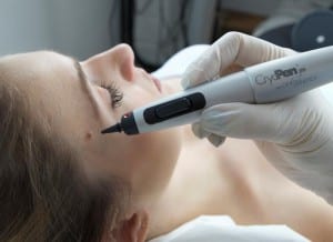 Cryopen skin imperfection removal