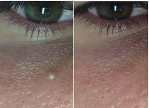Milia Removal