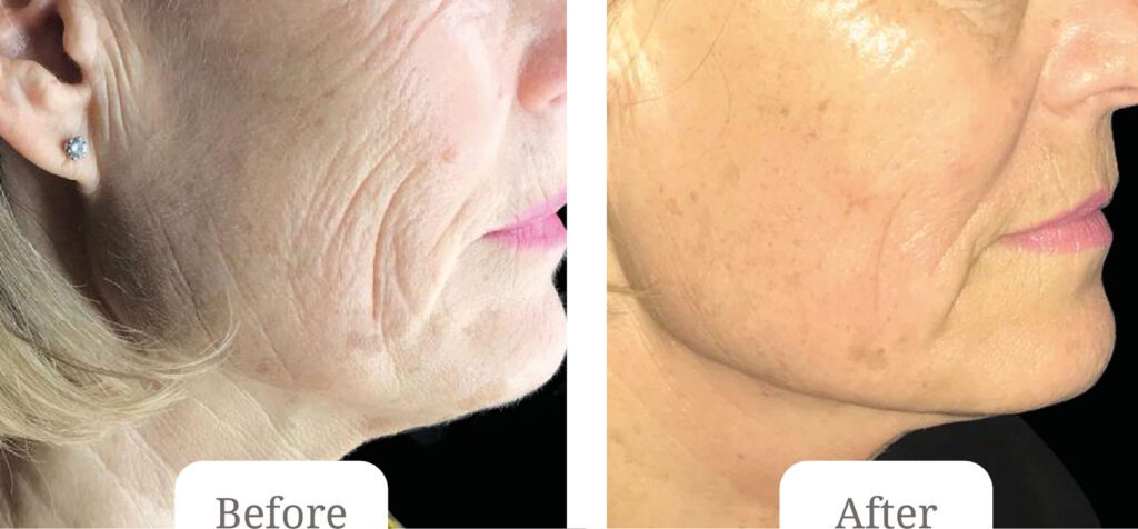 Autumn-Package - Restore Your Facial Profile