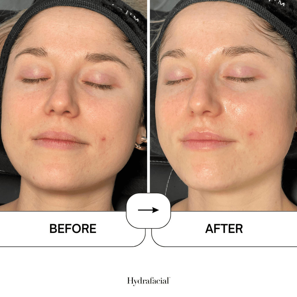 PEEL SENSITIVE AND GLYTONE