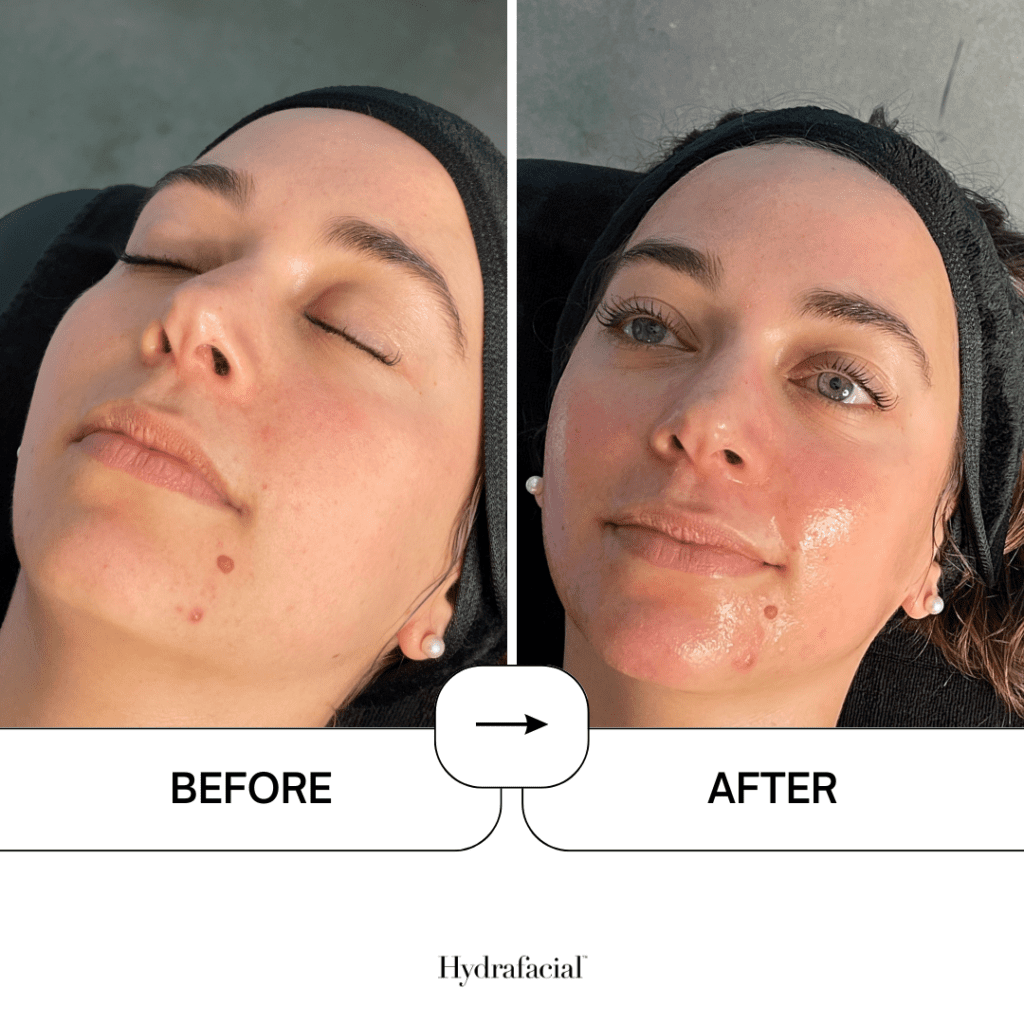 PEEL SENSITIVE AND MURAD CLARIFYING