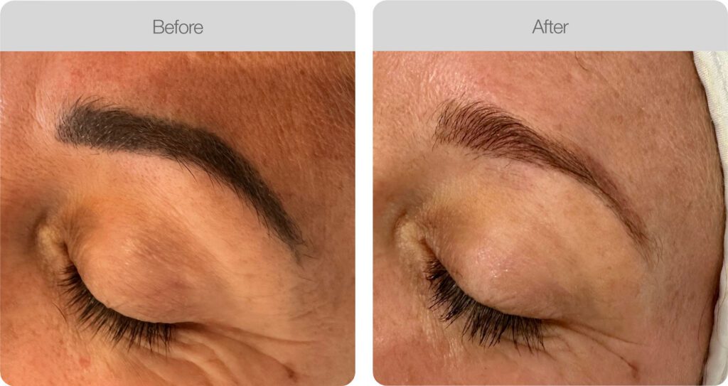 Eyebrow Tattoo Removal