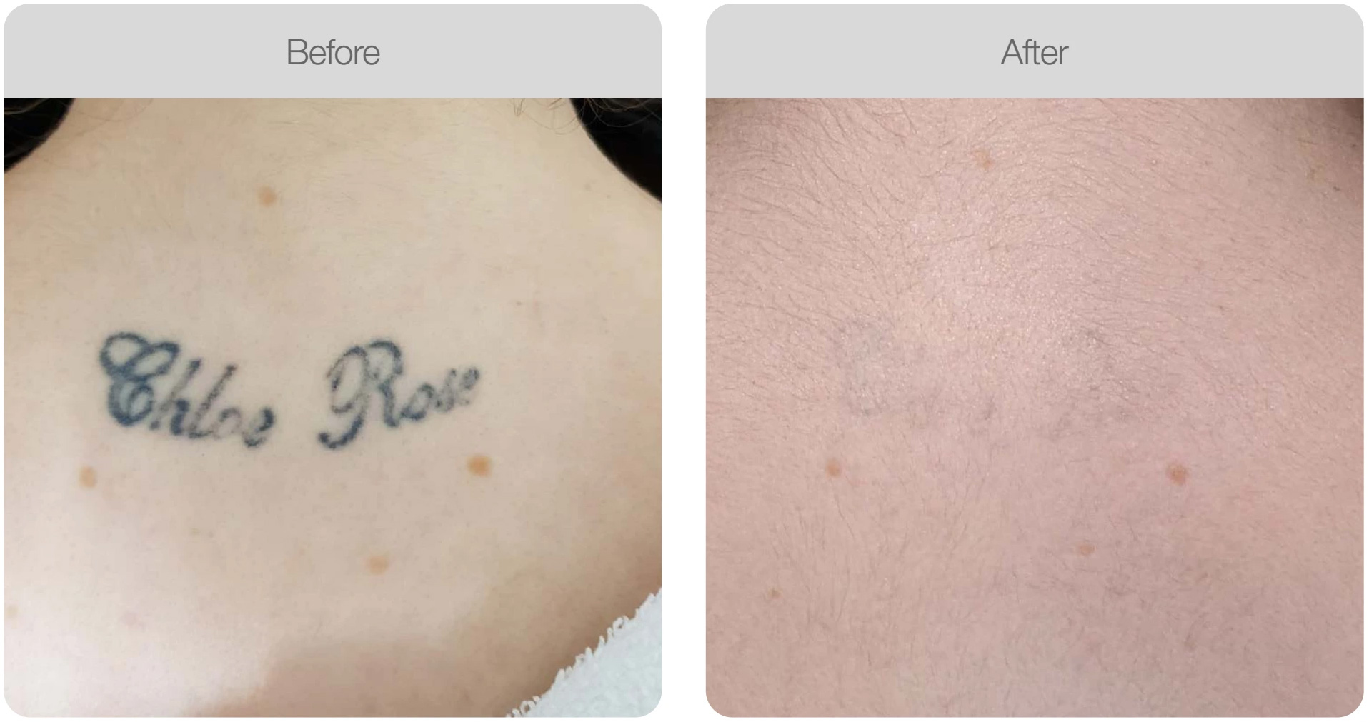 Laser Tattoo removal