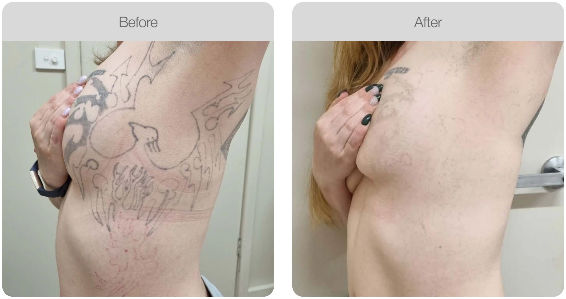 Laser Tattoo removal