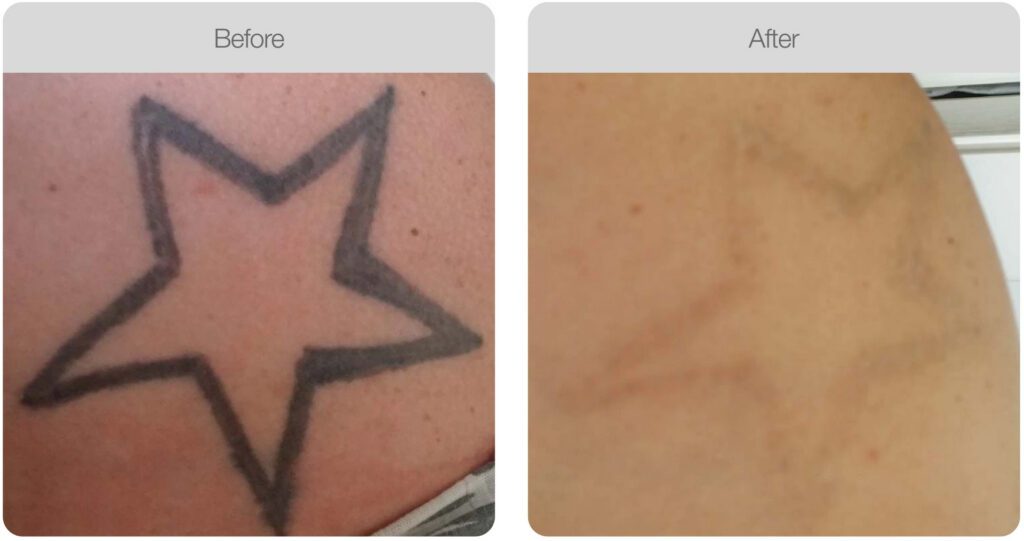 Tattoo removal in Hampshire